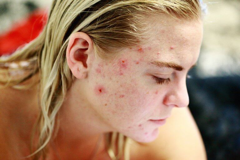 marques acne