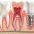 L’implant dentaire : l’alternative la plus efficace pour le remplacement de vos dents